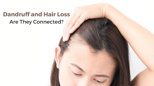 Dandruff and Hair Loss: Are They Connected